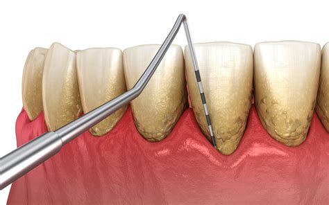 Stages Of Gum Disease Sparacino Periodontics