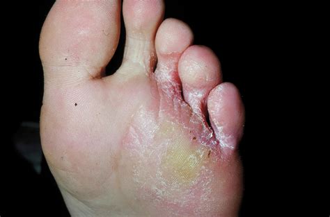 Vesicular Tinea Pedis