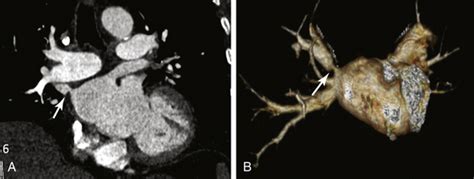 Percutaneous Treatment Of Pulmonary Vein Stenosis Thoracic Key