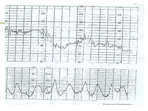 Cardiotocography Ctg Ppt