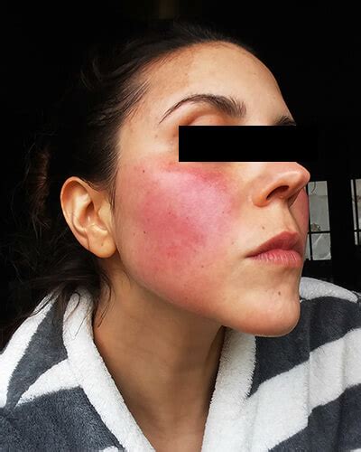 The Many Faces Of Rosacea