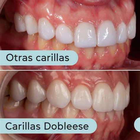 Carillas dentales precio cuánto cuestan en 2024 Dobleese