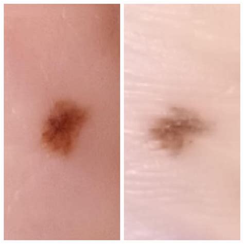 Possible Acral Melanoma! : r/Melanoma