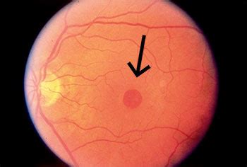 Macular Hole causes, symptoms, treatments | Assil Eye