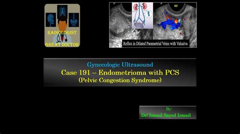 Ultrasound Case 191 Endometrioma With Pelvic Congestion Syndrome