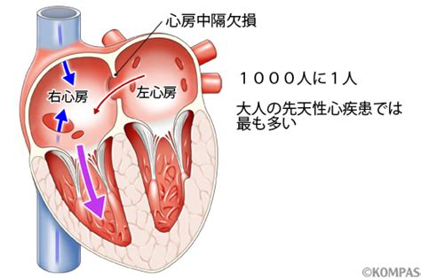 心房中隔欠損症（asd）のカテーテル治療 －循環器内科－｜kompas