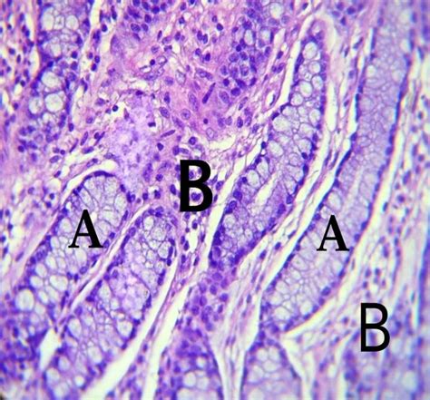 hyper secretion  mucus  intestinal glands  infiltration