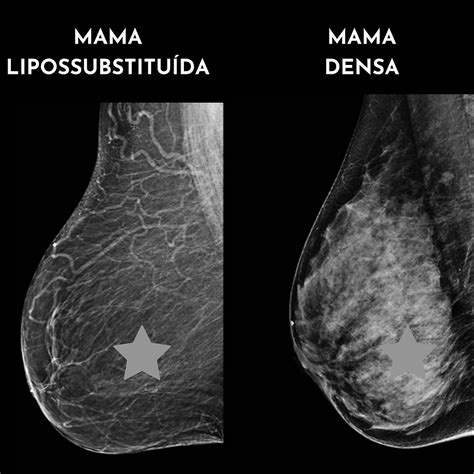 O Que Significa Mamas Densas