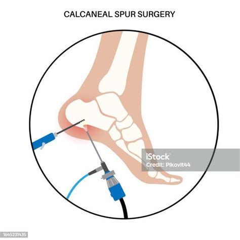 Heel Spur Surgery Stock Illustration Download Image Now Anatomy Ankle Arthroscopic Surgery