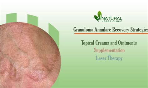 Proven Granuloma Annulare Recovery Strategies For Itchy Relief