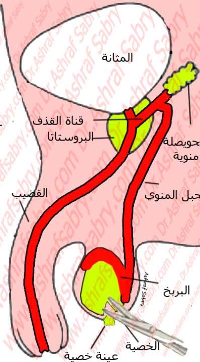 عينة من الخصية لغياب الحيوانات المنوية Dr Ashraf Sabry Consultant