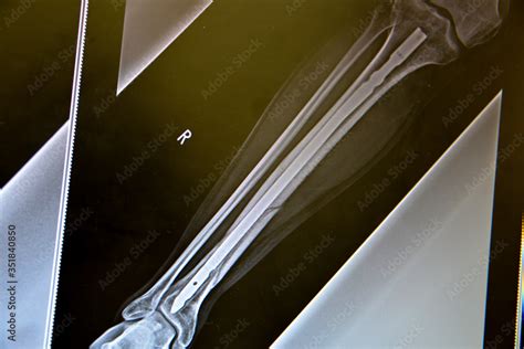 Broken right leg tibia surgery procedure. Metallic rod inserted inside ...