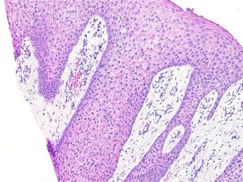 Clear Cell Acanthoma Histology