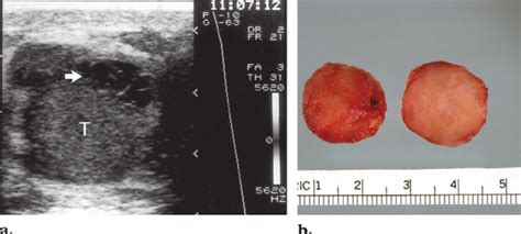 Adenomatoid Tumor Of The Epididymis A Us Image Shows An Download Scientific Diagram