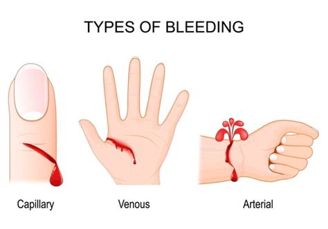 Capillary Venous Bleeding: Over 62 Royalty-Free Licensable Stock ...