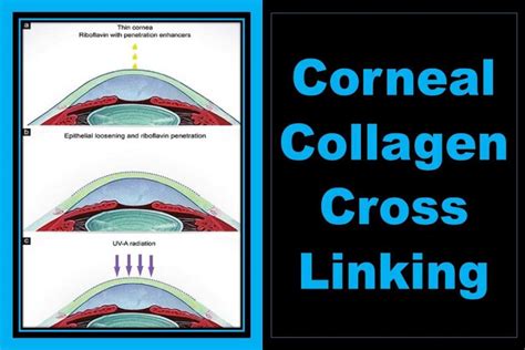 What Is Corneal Collagen Crosslinking Keratoconus Treatment Explained