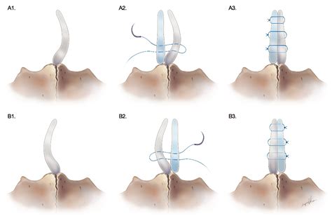 Healthcare Free Full Text Endonasal Septoplasty Using A Septal