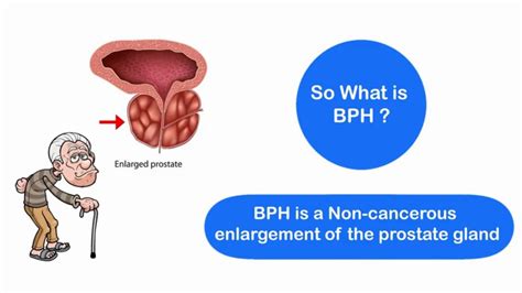 Benign Prostatic Hyperplasia Enlarged Prostate