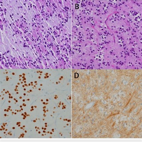 Histopathologic images from cerebellar vermis lesion. (A)... | Download Scientific Diagram