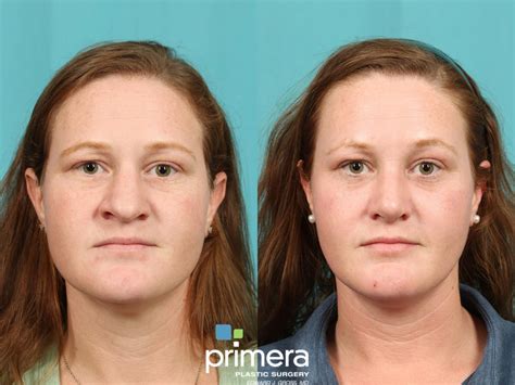 Rhinoplasty Before And After Pictures Case 780 Orlando And Tampa