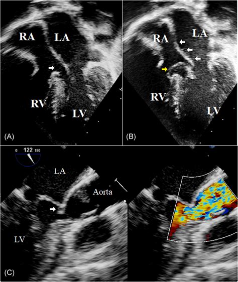 Preoperative Transthoracic Echocardiography And Trans‐esophageal