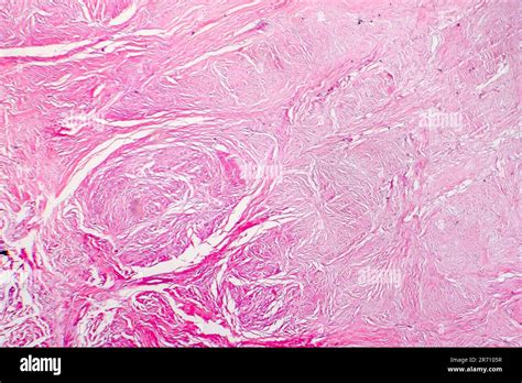 Light Micrograph Of Scar Tissue Photo Under Microscope Of A Scar Formed During Wound Healing