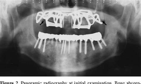 Figure 2 From Maxillary Subperiosteal Implantitis That Caused Severe