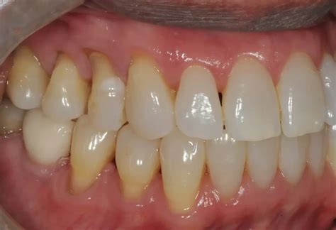 Gum Graft Before And After Photos Westcoast Smile