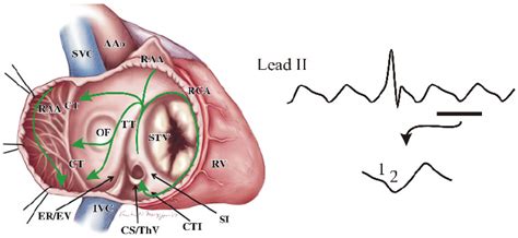 Typical Atrial Flutter The Wave Of Activation Travels In A Counter