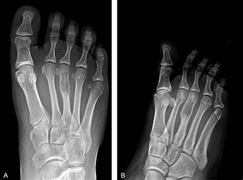 A Rare Presentation Of Ewing S Sarcoma Presenting In The Third