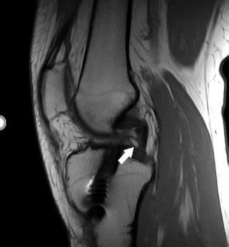 Sagittal T1W MRI of a 32-year-old man following post ACL reconstruction ...