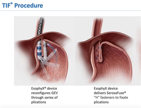 What is GERD: Symptoms, Treatements, Surgery & Cost