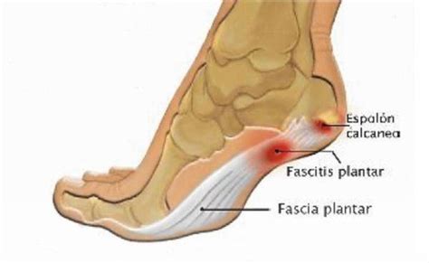 Fascitis plantar síntomas ejercicios y tratamiento Demedicina