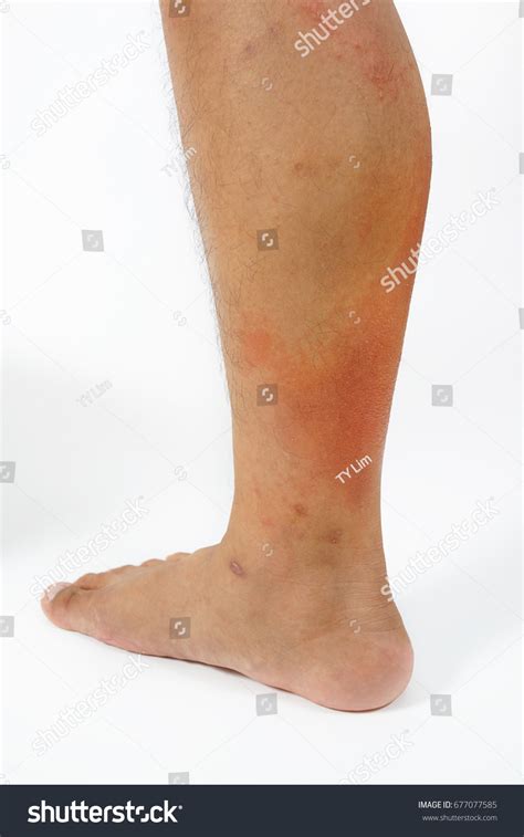 Allergic Rash Dermatitis Skin On Patients Stock Photo 677077585 ...