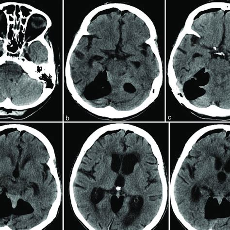 Tension Pneumocephalus After Repeat Microvascular Decompression A F