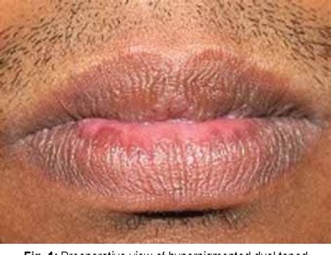 Hyperpigmentation Of Lips And Buccal Mucosa At Markcallen Blog