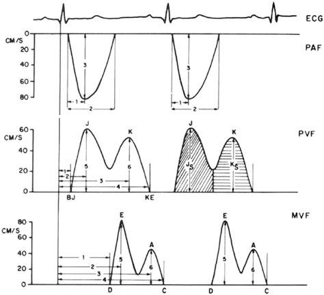 Intracardiac Blood Flow Dynamics Taken From 8 With Permission From