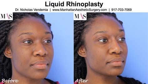 liquid rhinoplasty    bridge