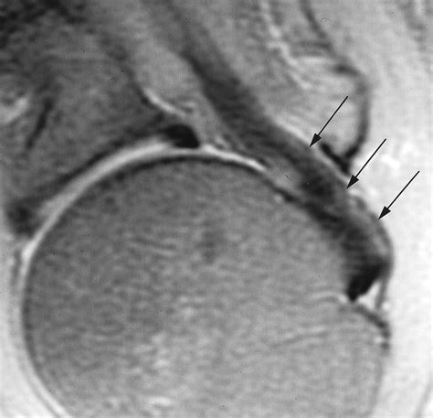 Coracohumeral Interval Imaging In Subcoracoid Impingement Syndrome On