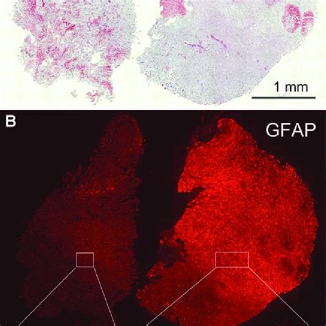 Glial Fibrillary Acidic Protein Gfap Immunoreactivity Dichotomizes