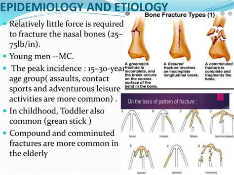 Nasal And Facial Fractures Ppt