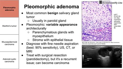 Parotid Salivary Gland Cancer