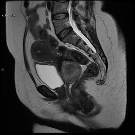 Prolapsed Submucosal Uterine Fibroid Image