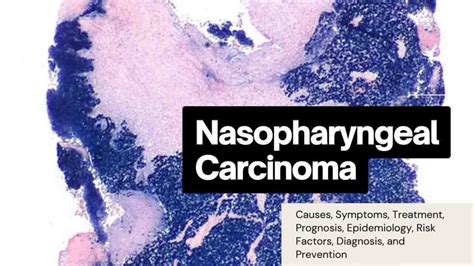 Nasopharyngeal Carcinoma: Causes, Symptoms, Treatment, Prognosis ...