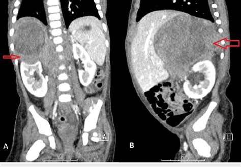 Abdominal And Pelvic Ct With Contrast A Coronal And B Sagittal