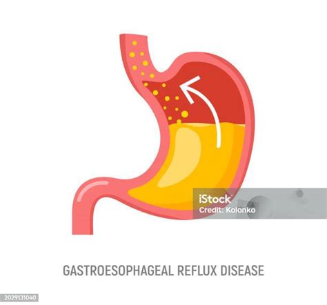 Gastroesophageal Reflux Disease Stomach Gerd Heartburn Esophagus