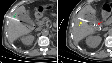 Percutaneous Cholecystostomy