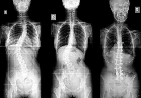 Scoliosis Treatment Options Scoliosis Solutions