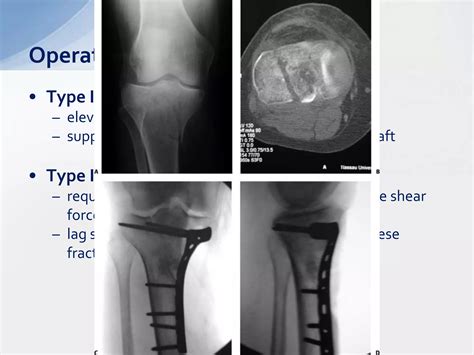 Tibial plateau fractures | PPTX