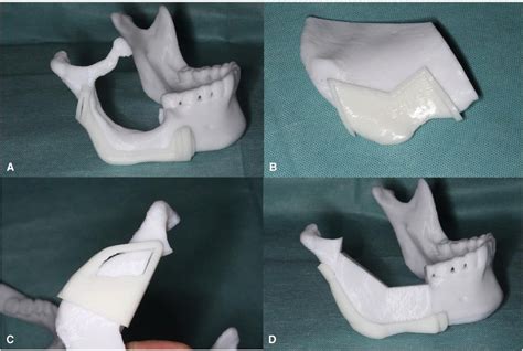 Frontiers Mandibular Reconstruction With The Contralateral Vascularized Iliac Flap Using